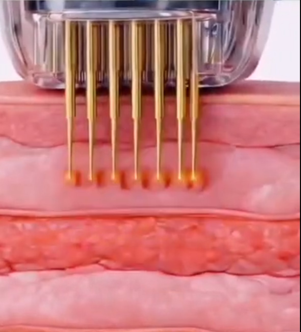 MBS DermaPure RF-Mikroneedling System